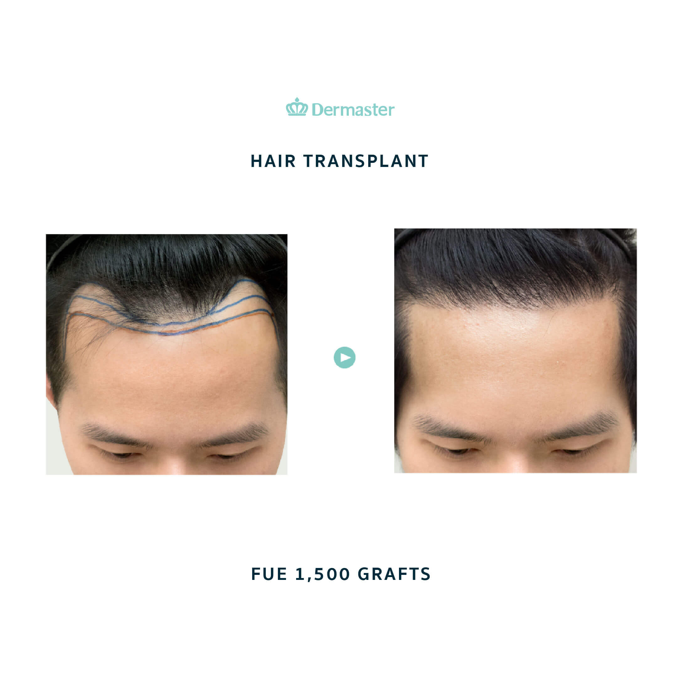 dermaster-before-hair-transplant-02