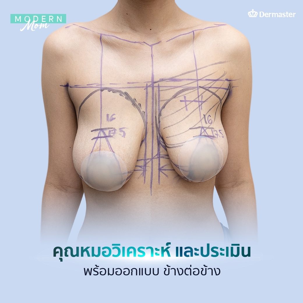 dermaster-breast-lift-09