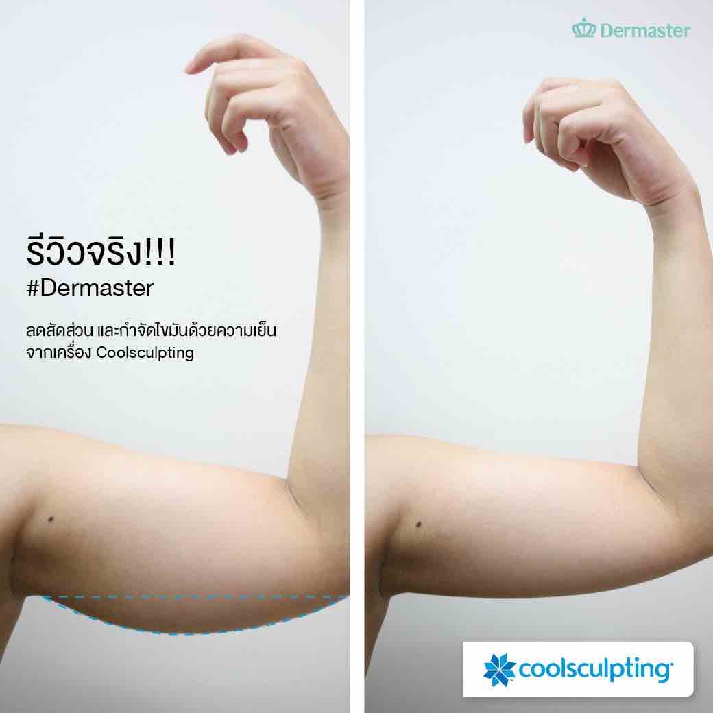 Before & After Coolsculpting