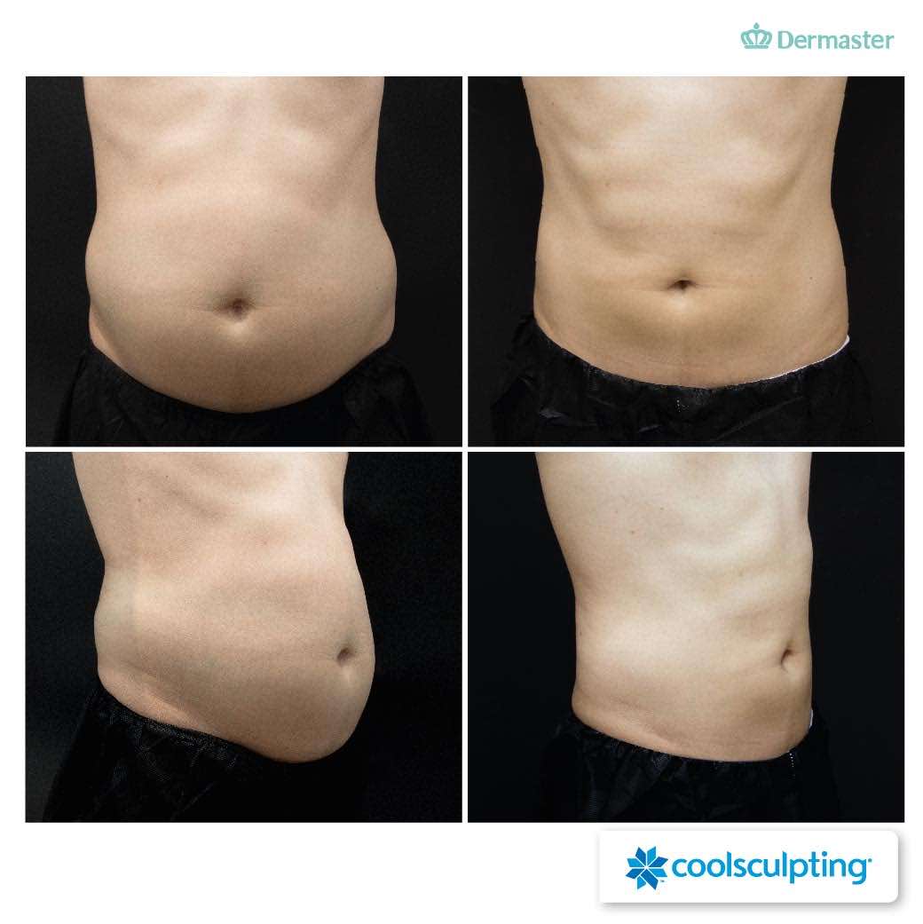 Before & After Coolsculpting