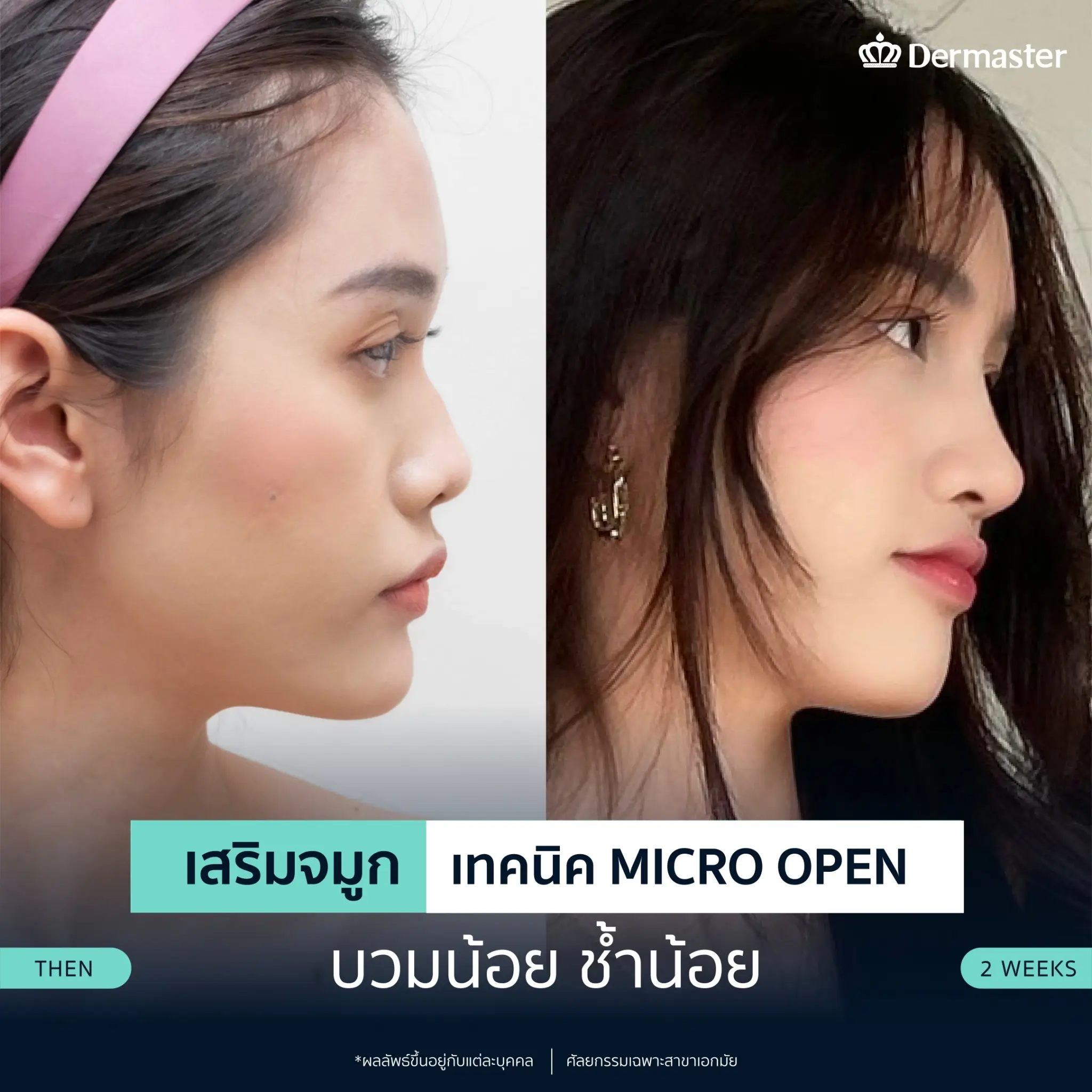 dermaster-thailand-nose-micro-open (1)