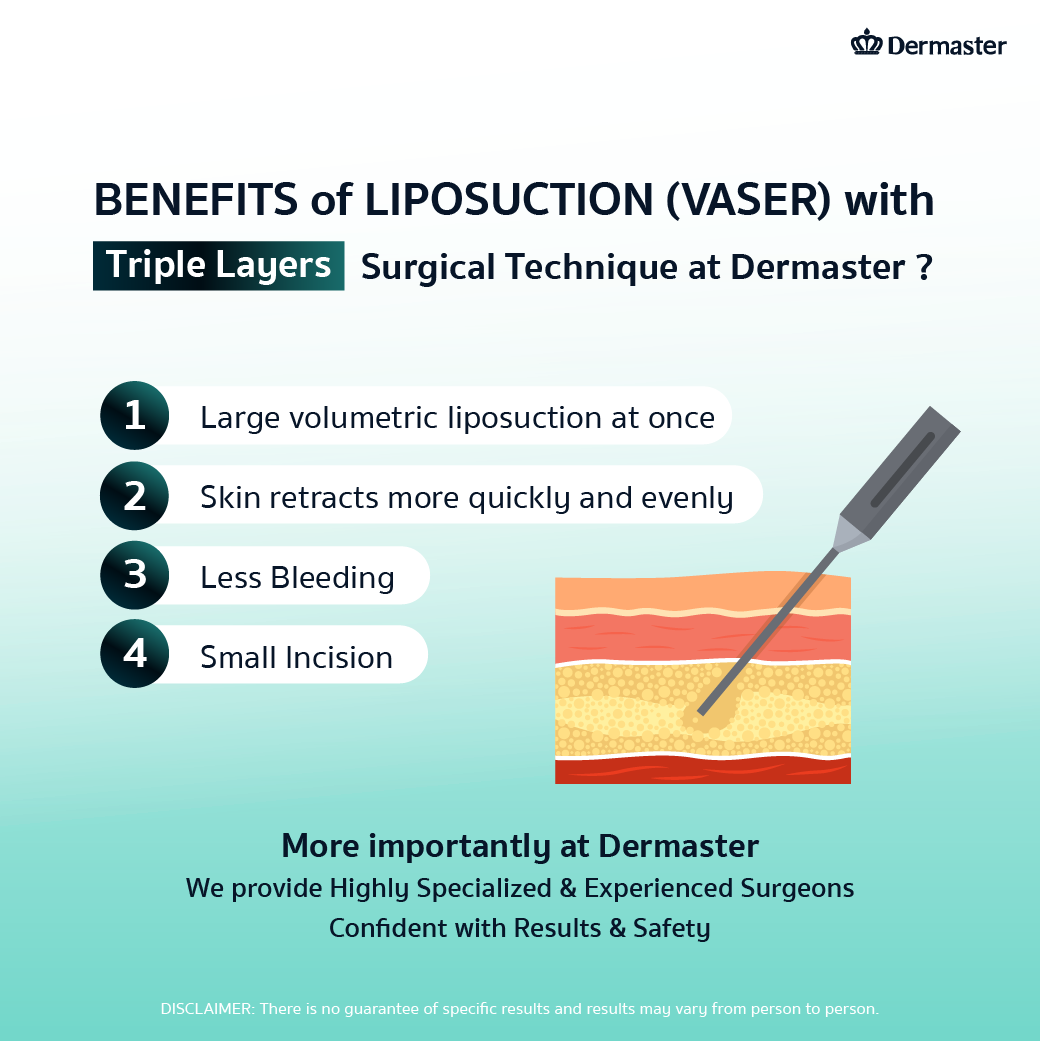 Benefits of Liposuction (VASER)