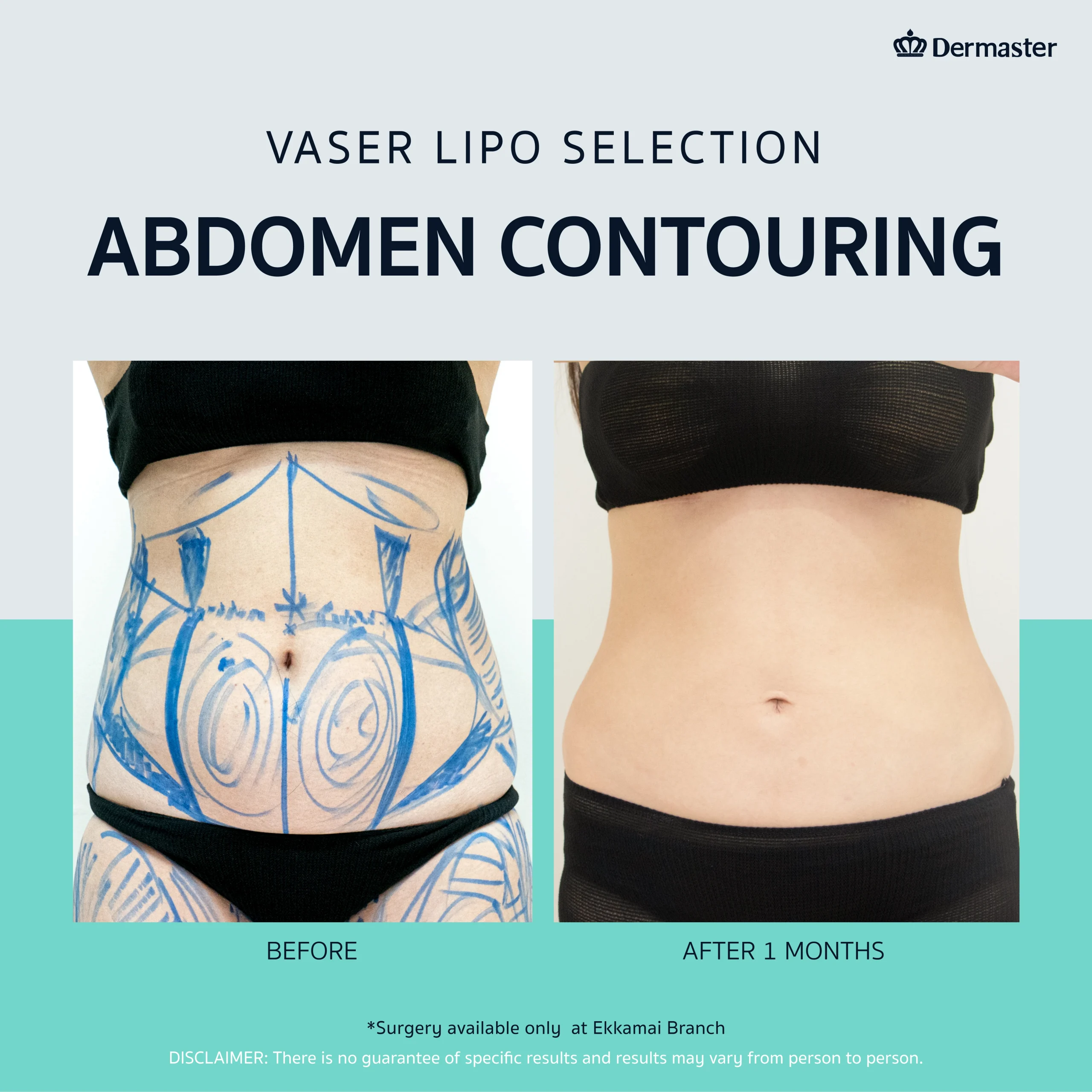 Contour Your Body With Vaser Triple Layers Liposuction - Dermaster
