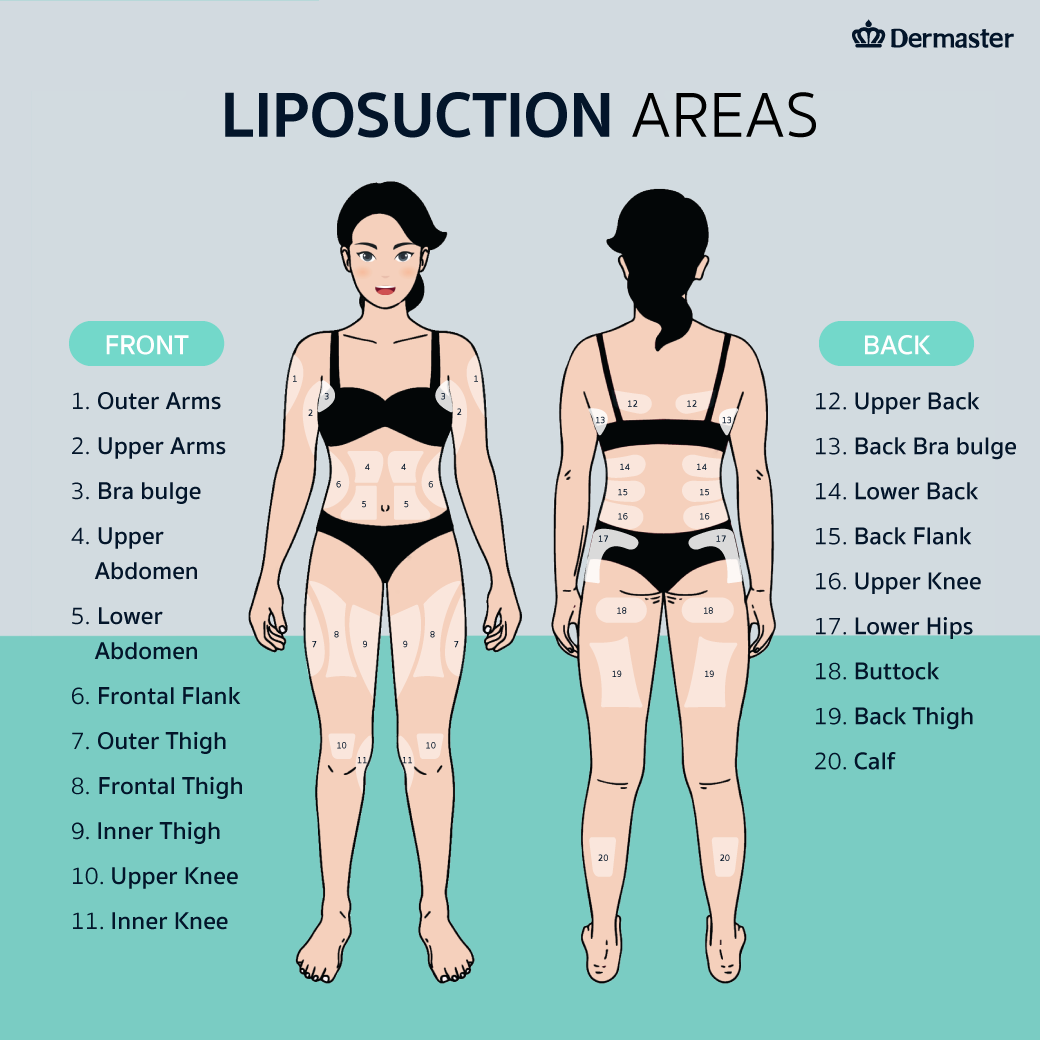 รูปภาพ Liposuction Areas โดย Dermaster Thailand Vaser Tite