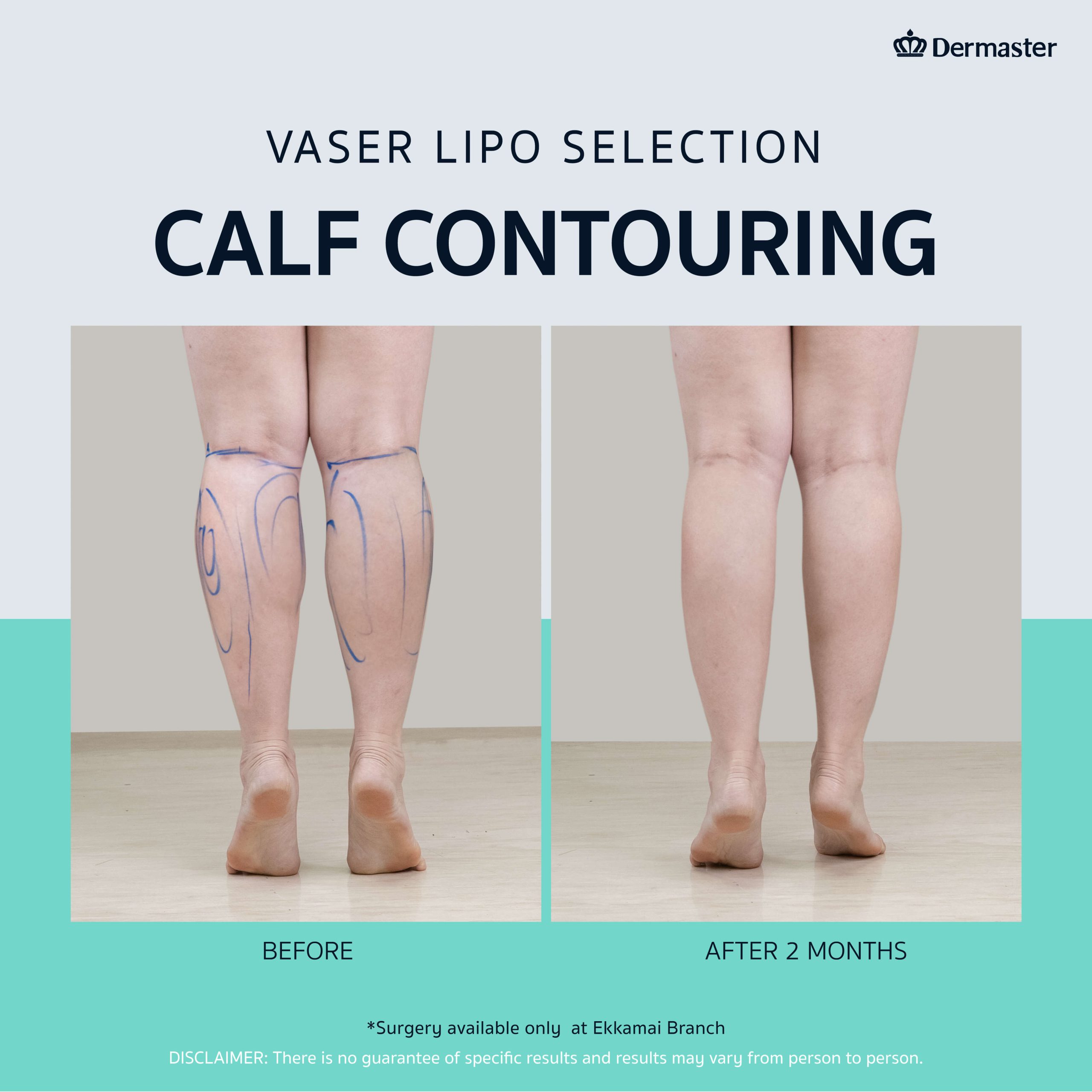 dermaster-thailand-vaser-liposuction-ดูดไขมัน-7