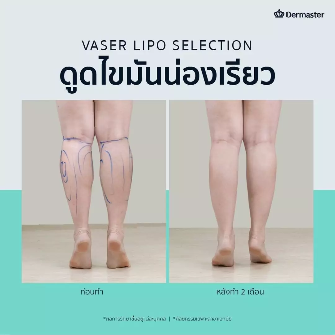 dermaster-thailand-vaser-ดูดไขมัน-review-14