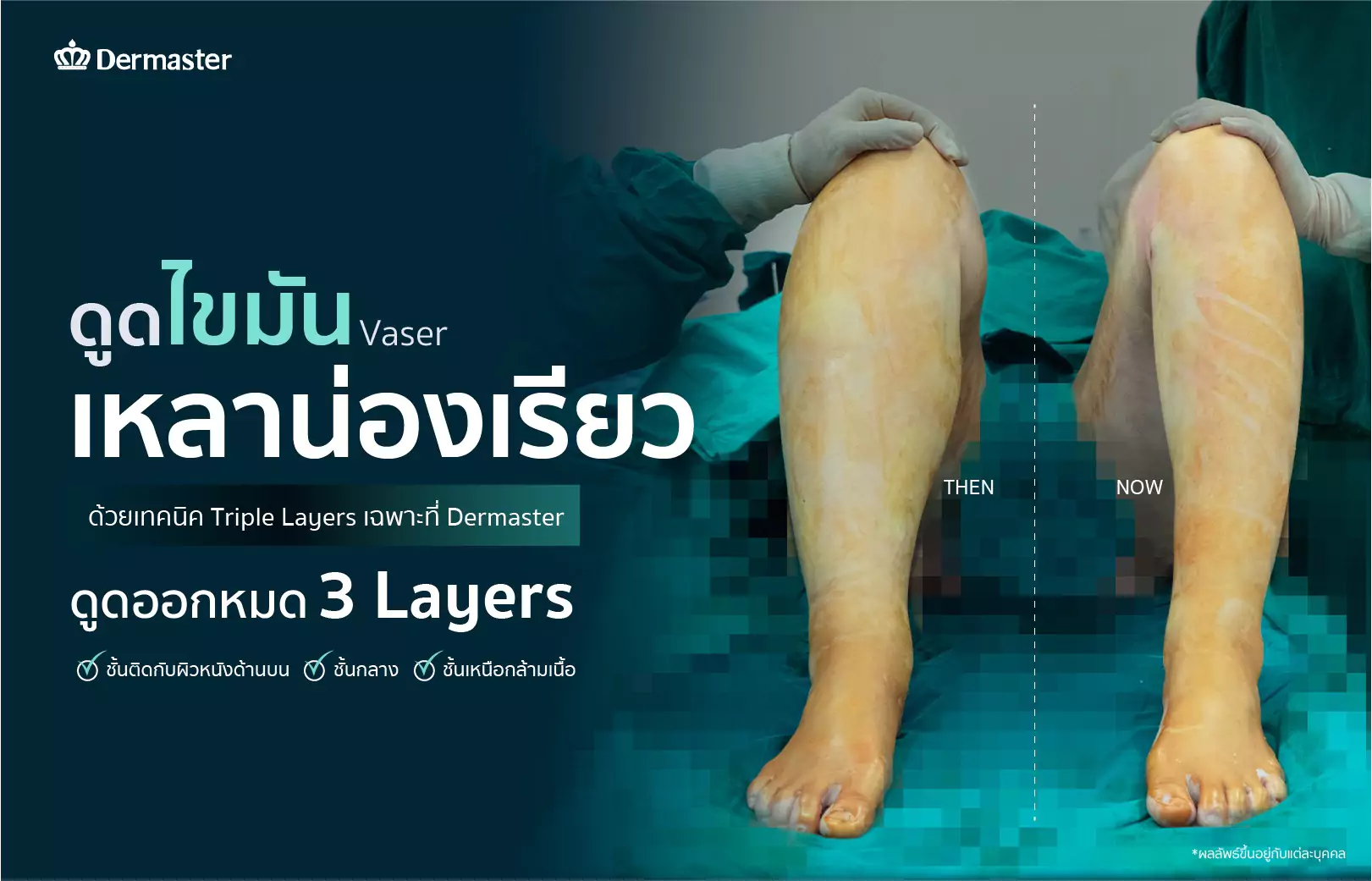 dermaster-thailand-vaser-ดูดไขมัน-review-9