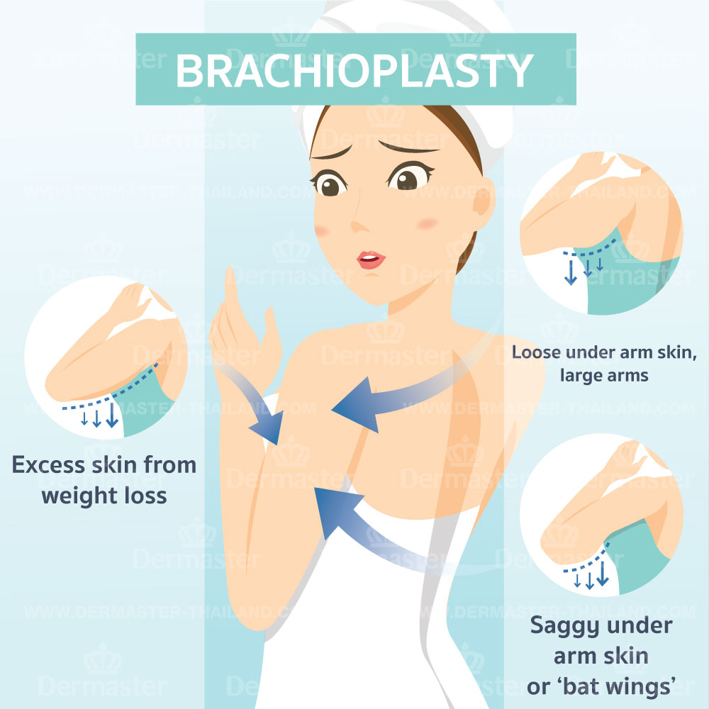 problem-brachioplasty-en
