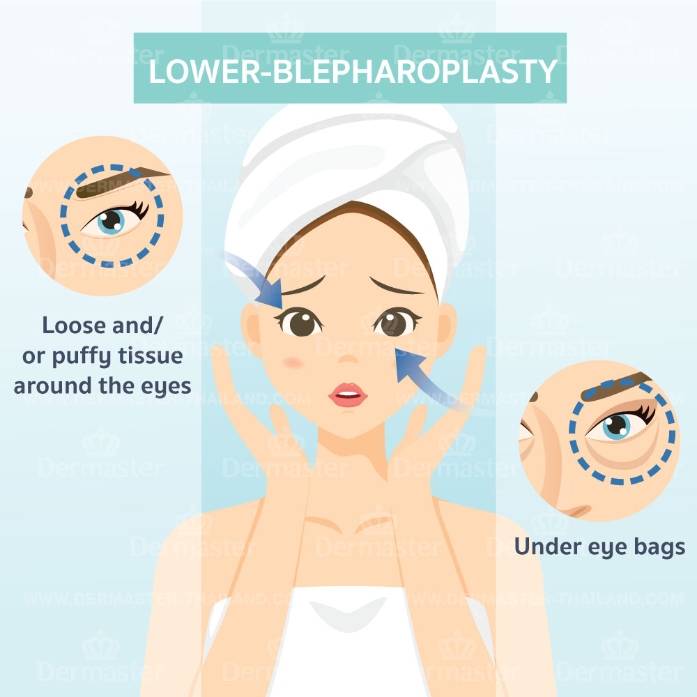 problem-lower-blepharoplasty-en