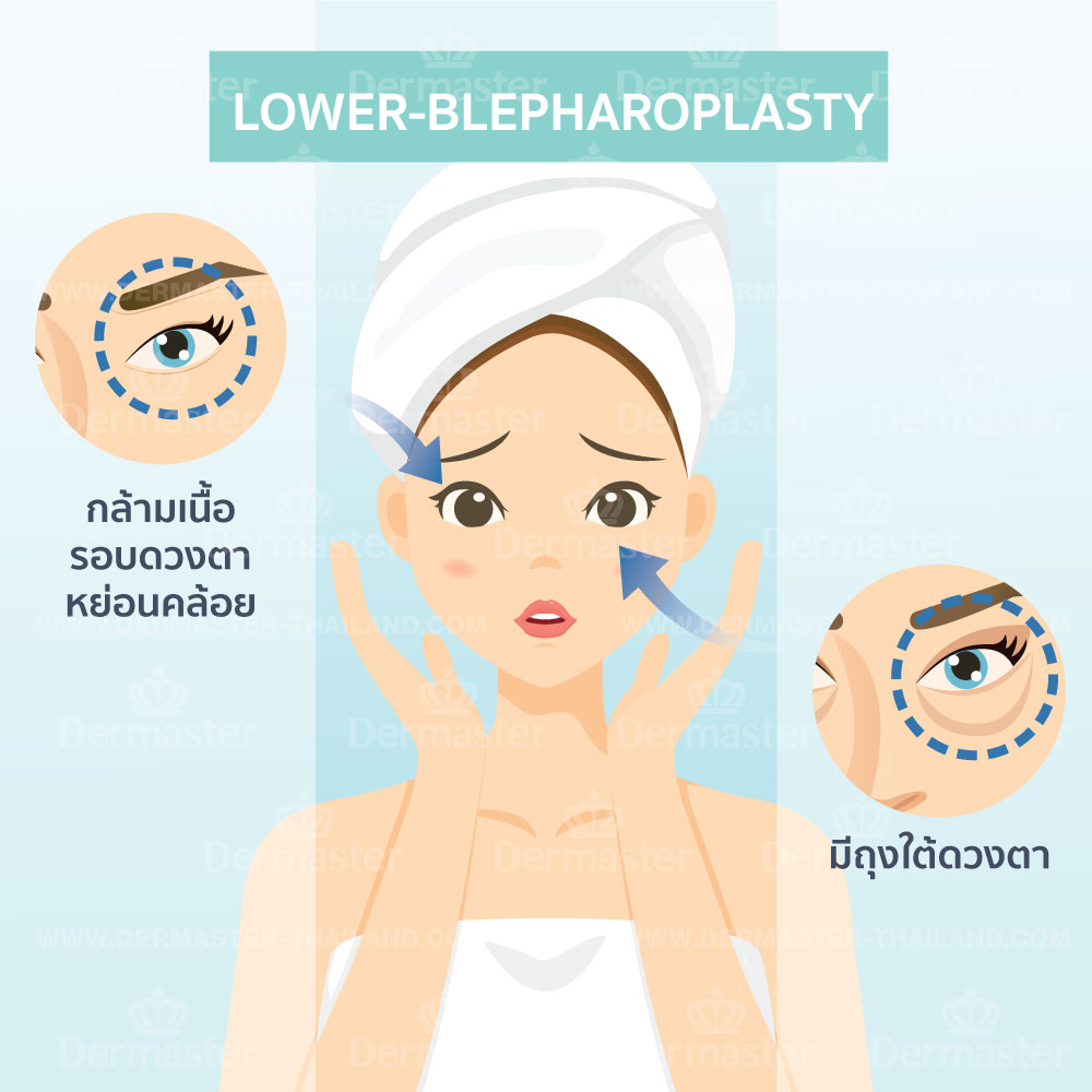 problem-lower-blepharoplasty