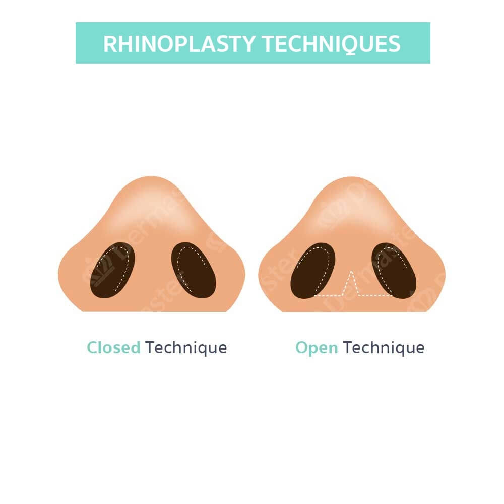 problem-rhinoplasty-en02
