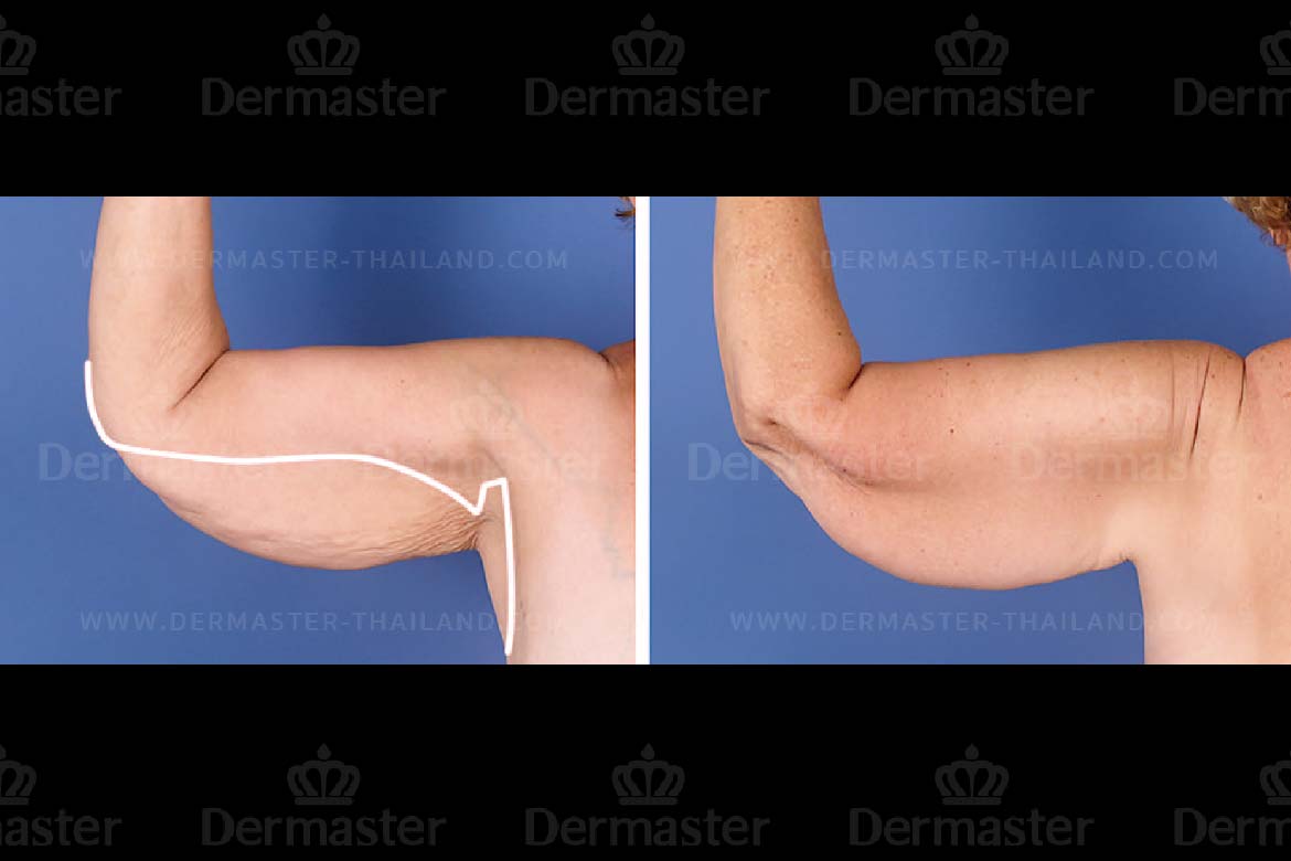 service-dermaster-brachioplasty-2