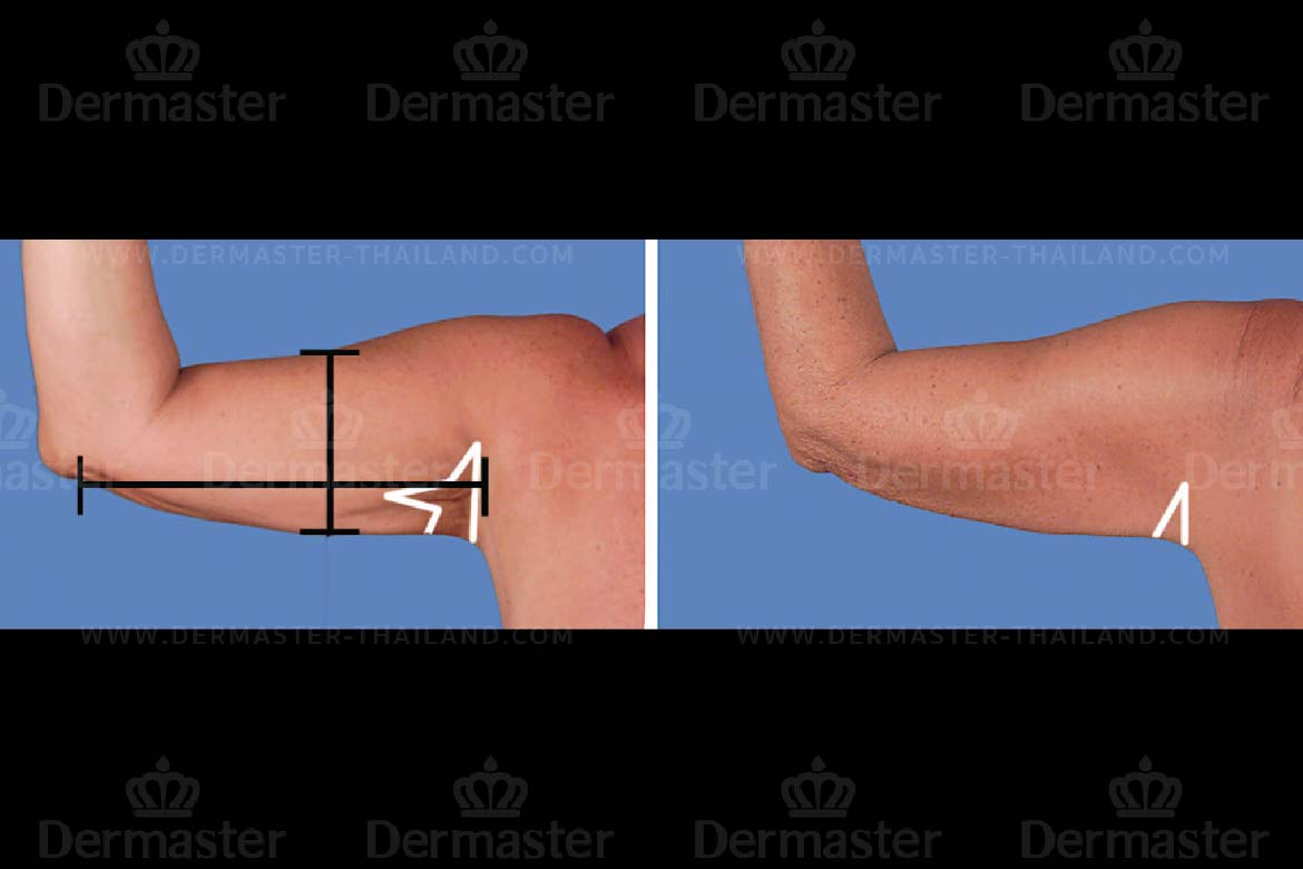 service-dermaster-brachioplasty-5