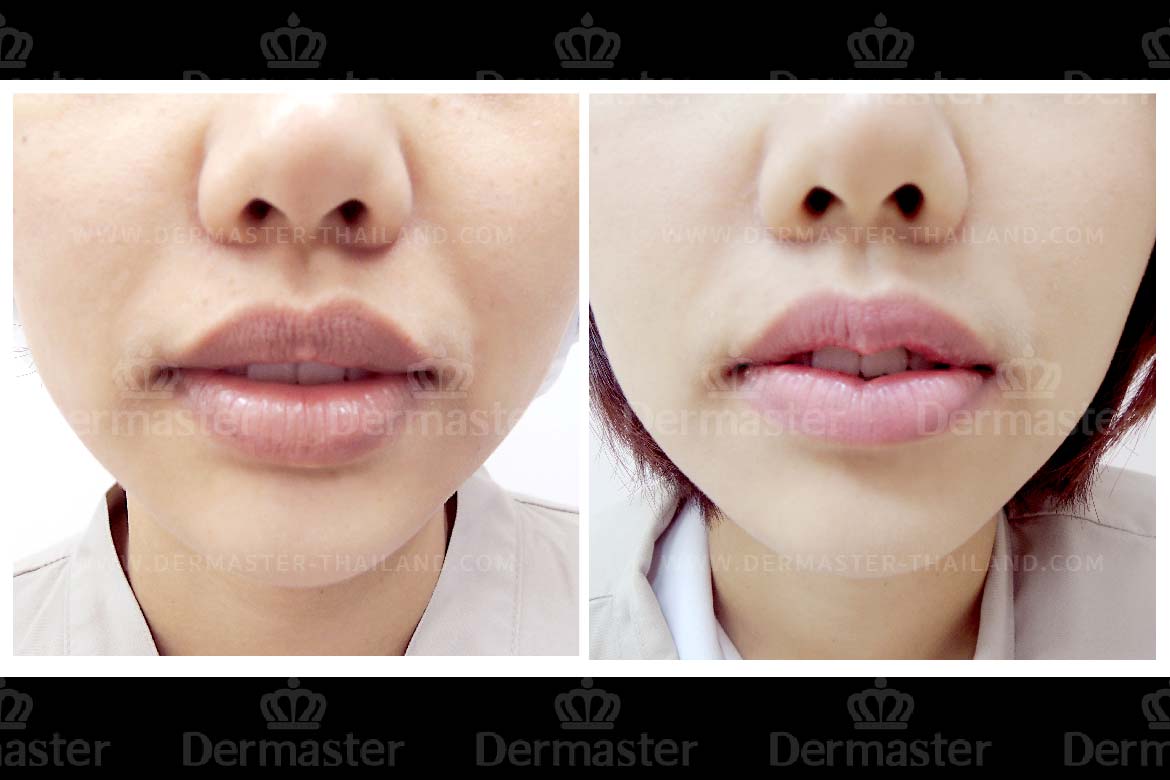 service-dermaster-lips-2