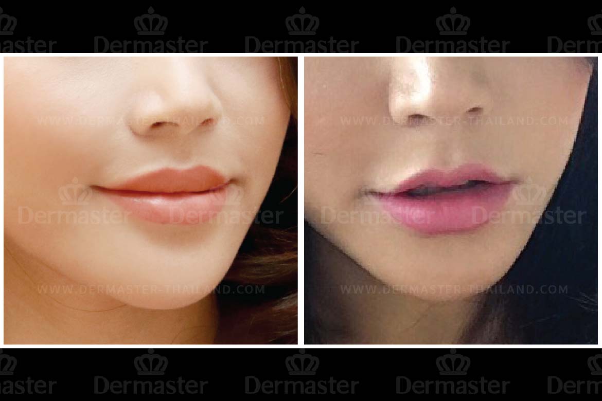 service-dermaster-lips-3