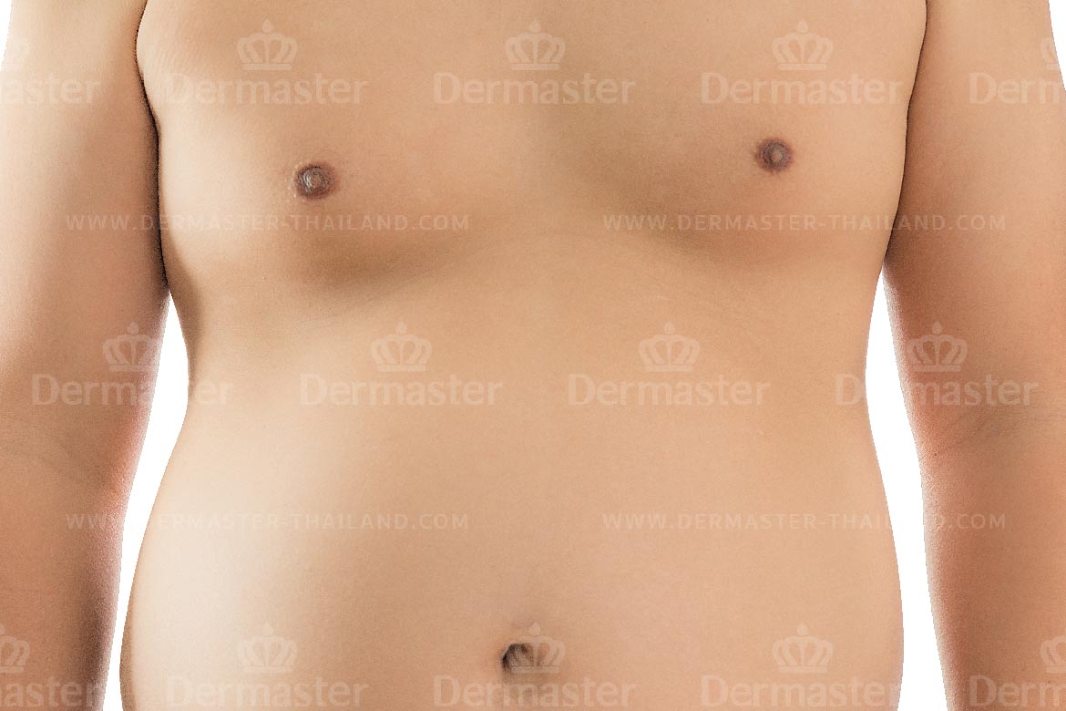 service-dermaster-male-breast-reduction-1