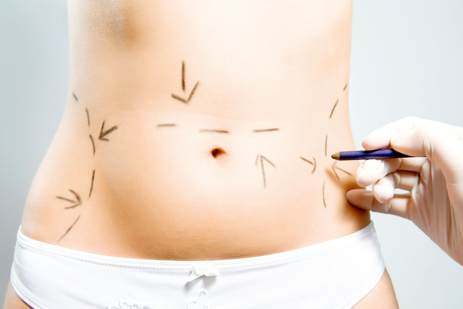 Tummy Tuck A Smoother And Firmer Abdomen - Dermaster