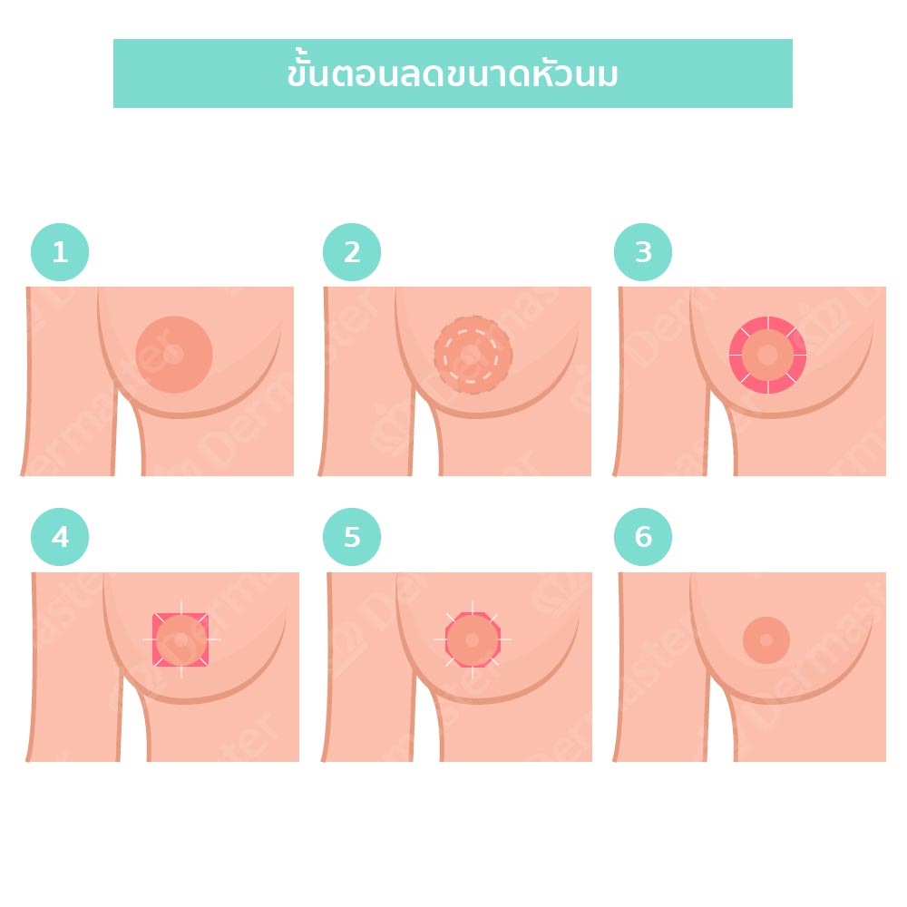 why-dermaster-nipple-reduction-4