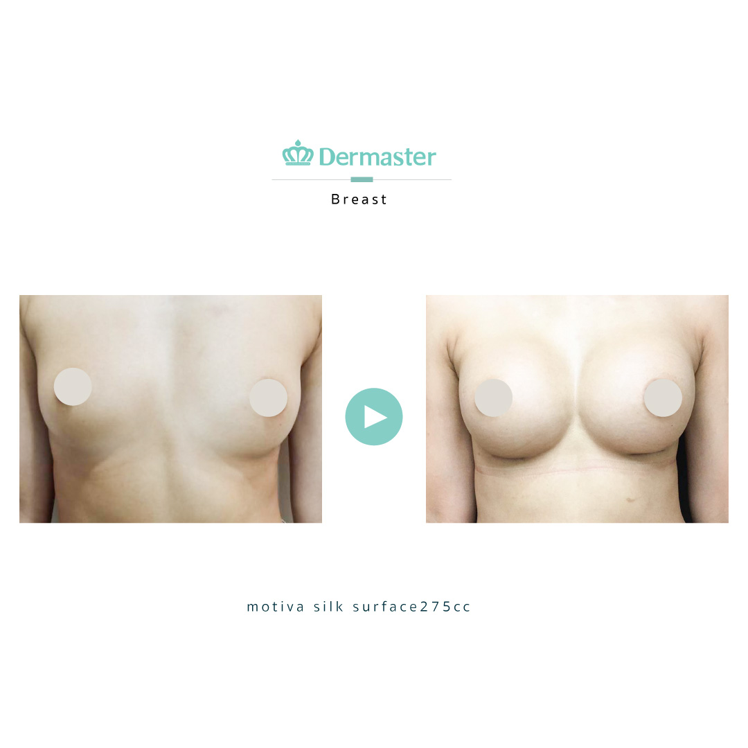 dermaster-motiva-breast-augmentation-review-02