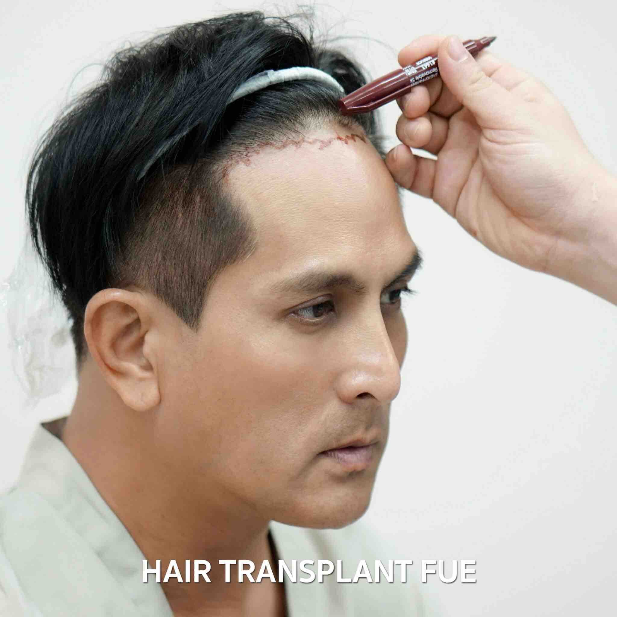 dermaster-poppular-services-hair-transplant-fue