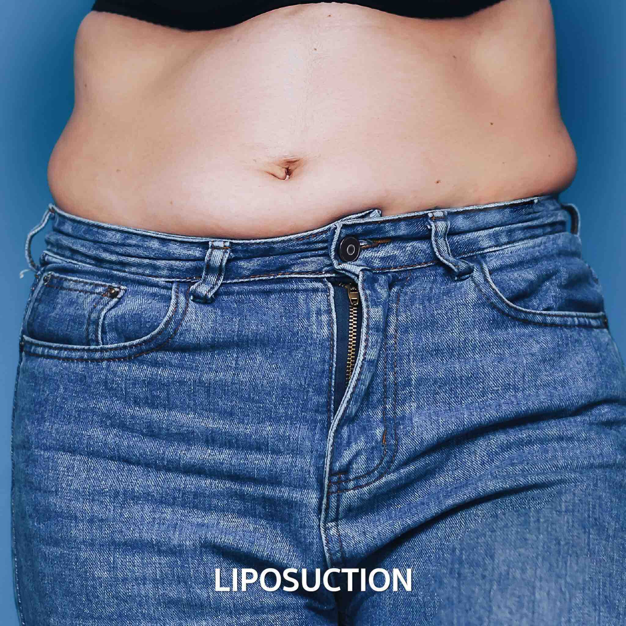 dermaster-poppular-services-liposuction