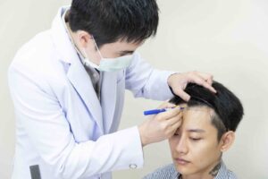 โรคผมร่วงเป็นหย่อม Alopecia Areata