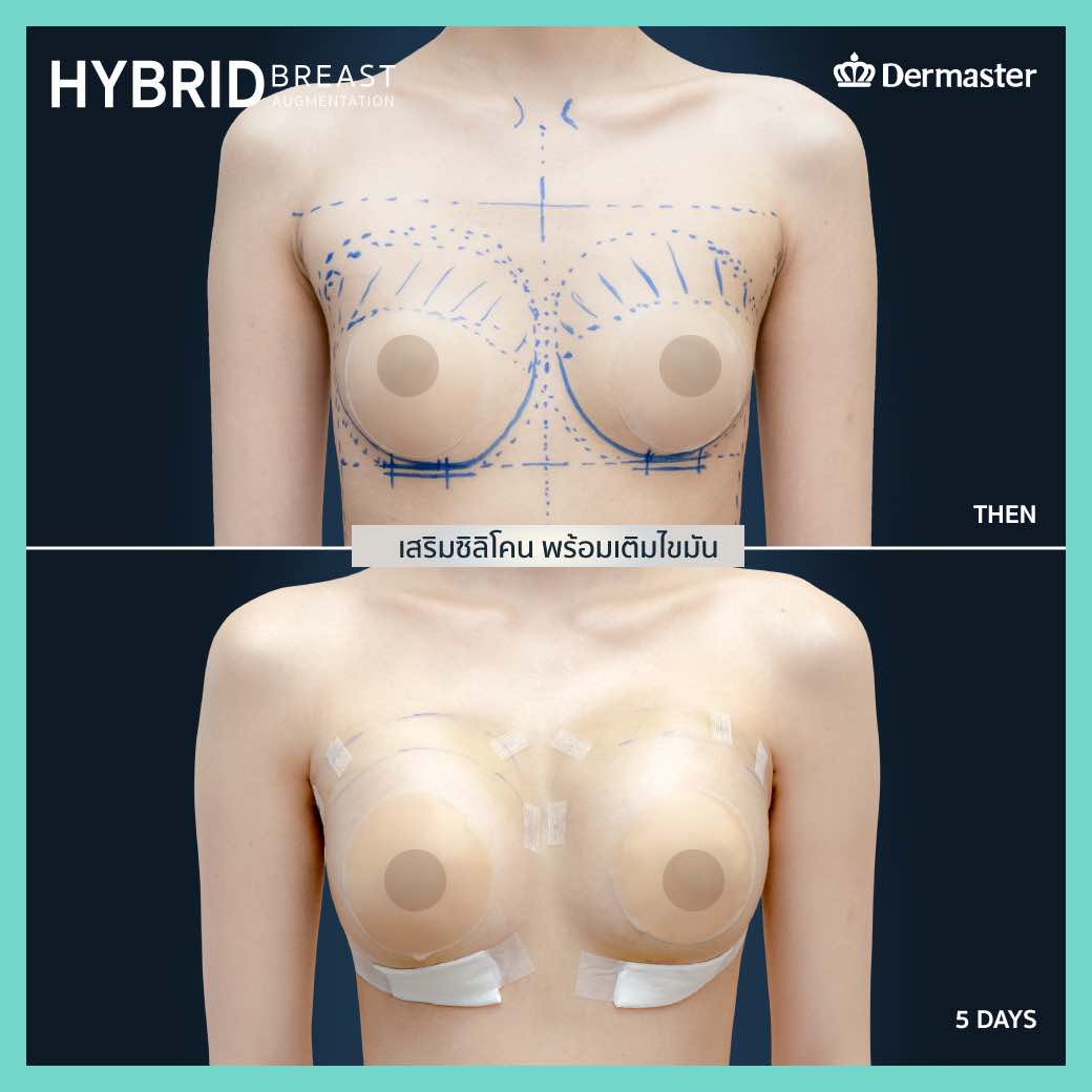 dermaster-hybrid_breast-07