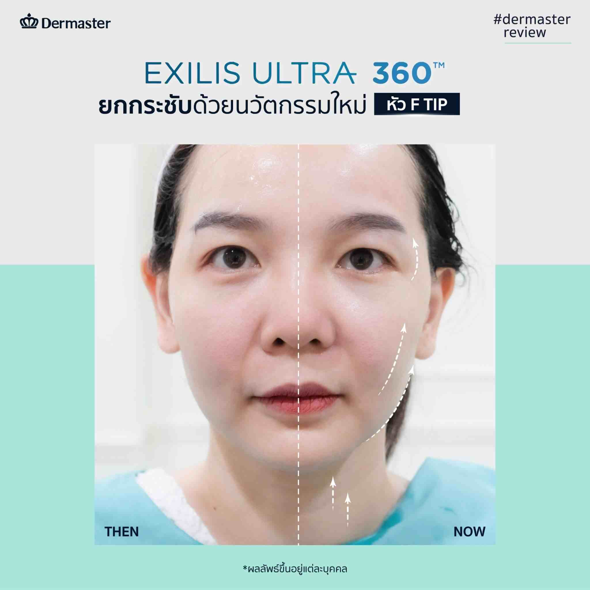 dermaster-thailand-exilis-ultra-360-facial-3