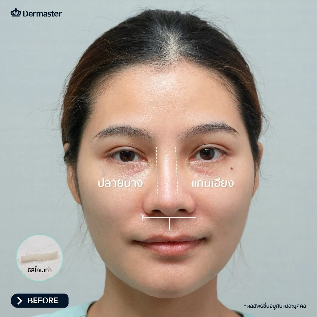 เสริมจมูกทรงสโลป ปลายพุ่ง - Rhinoplasty Dermaster