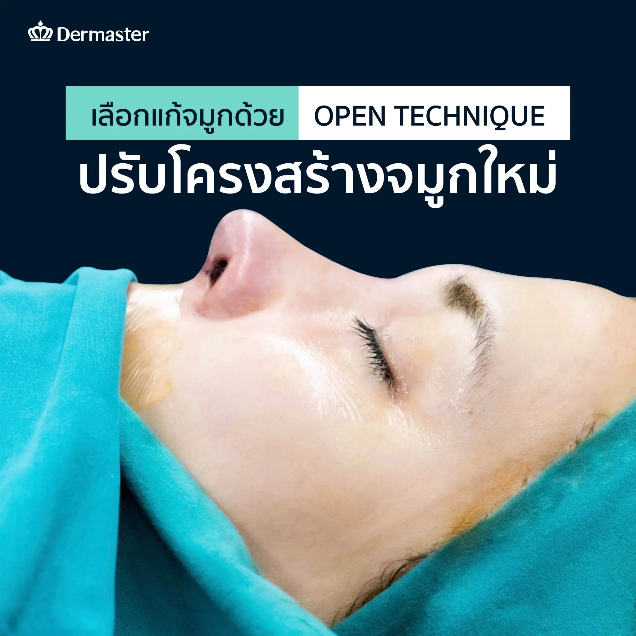 dermaster-thailand-nose-surgery-open-technique-mamiew-A
