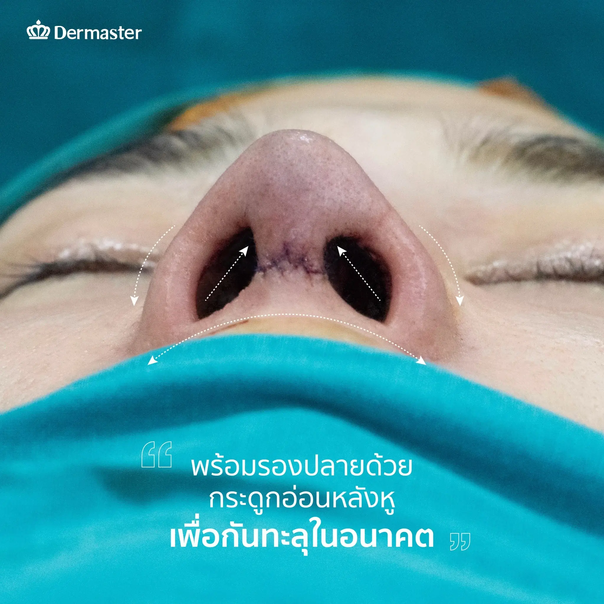 dermaster-thailand-nose-surgery-open-technique-mamiew-B