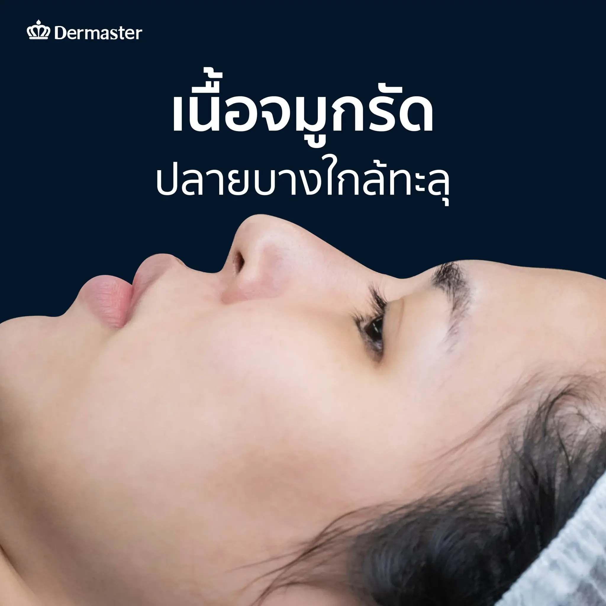 dermaster-thailand-nose-surgery-open-technique-mamiew-C