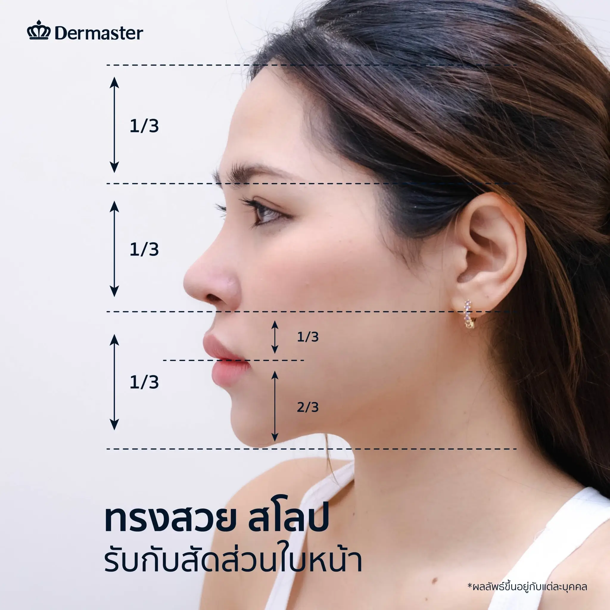 dermaster-thailand-nose-surgery-open-technique-mamiew-D