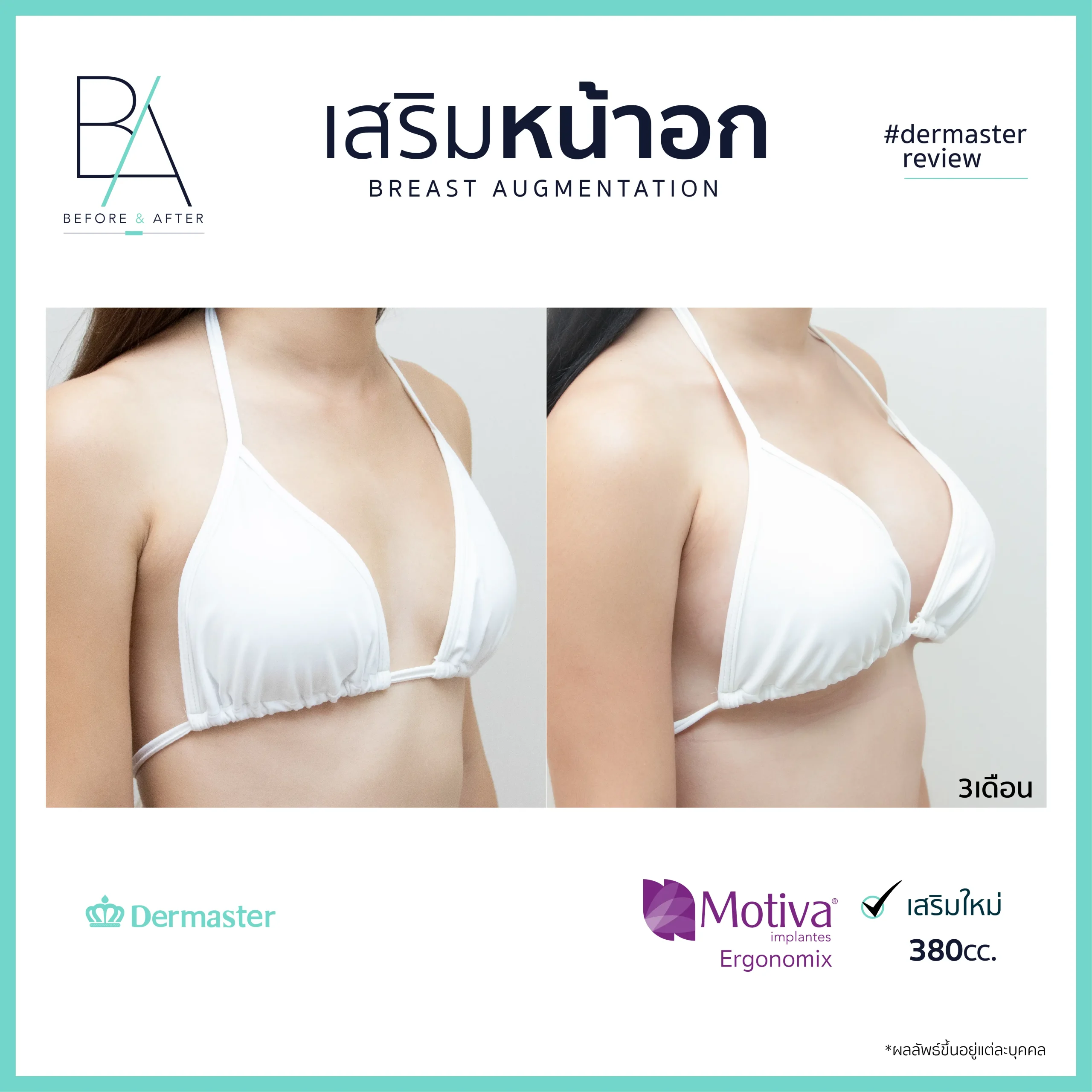 dermaster-motiva-breast-augmentation-review