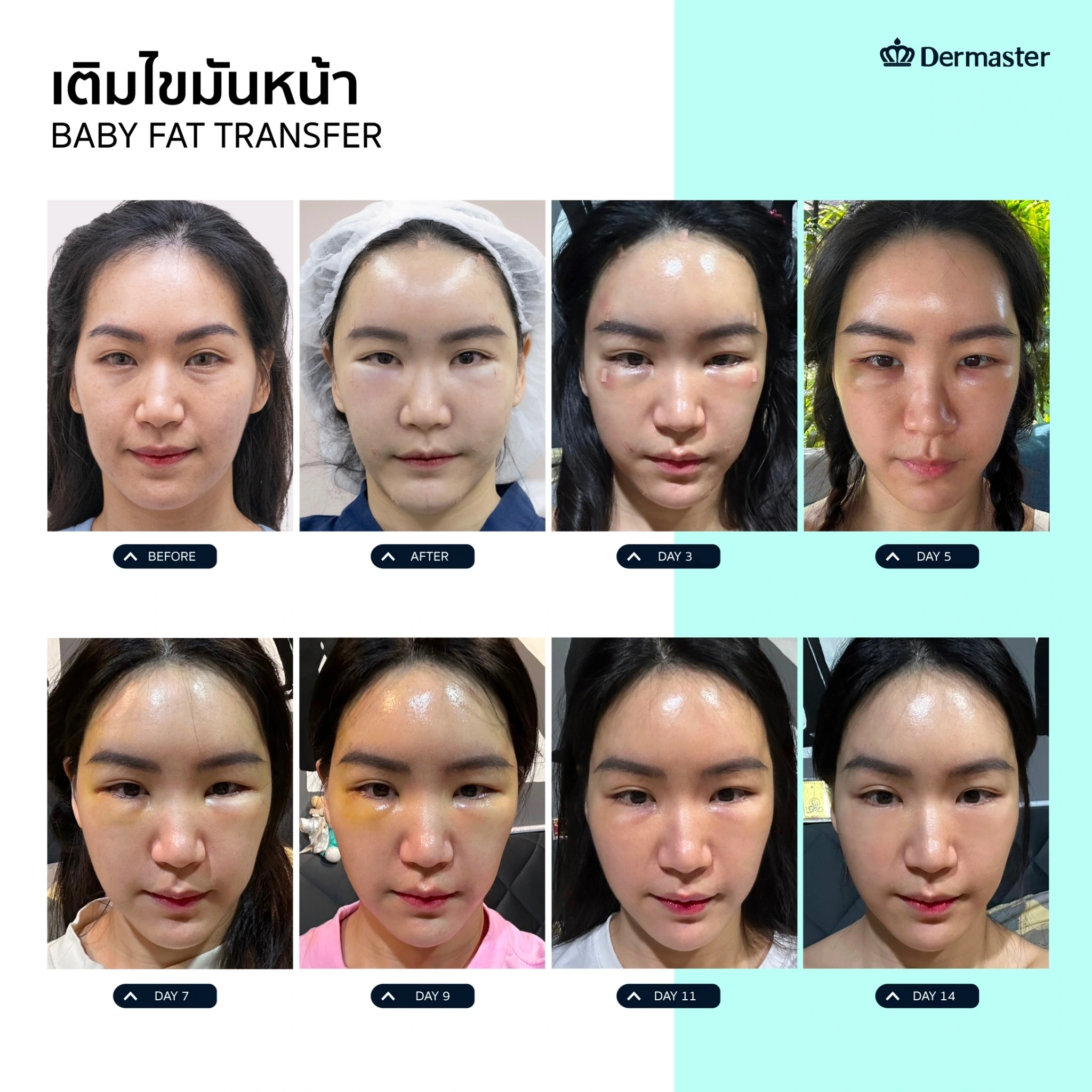 dermaster-thailand-baby-fat-transfer-before-and-after-14-days