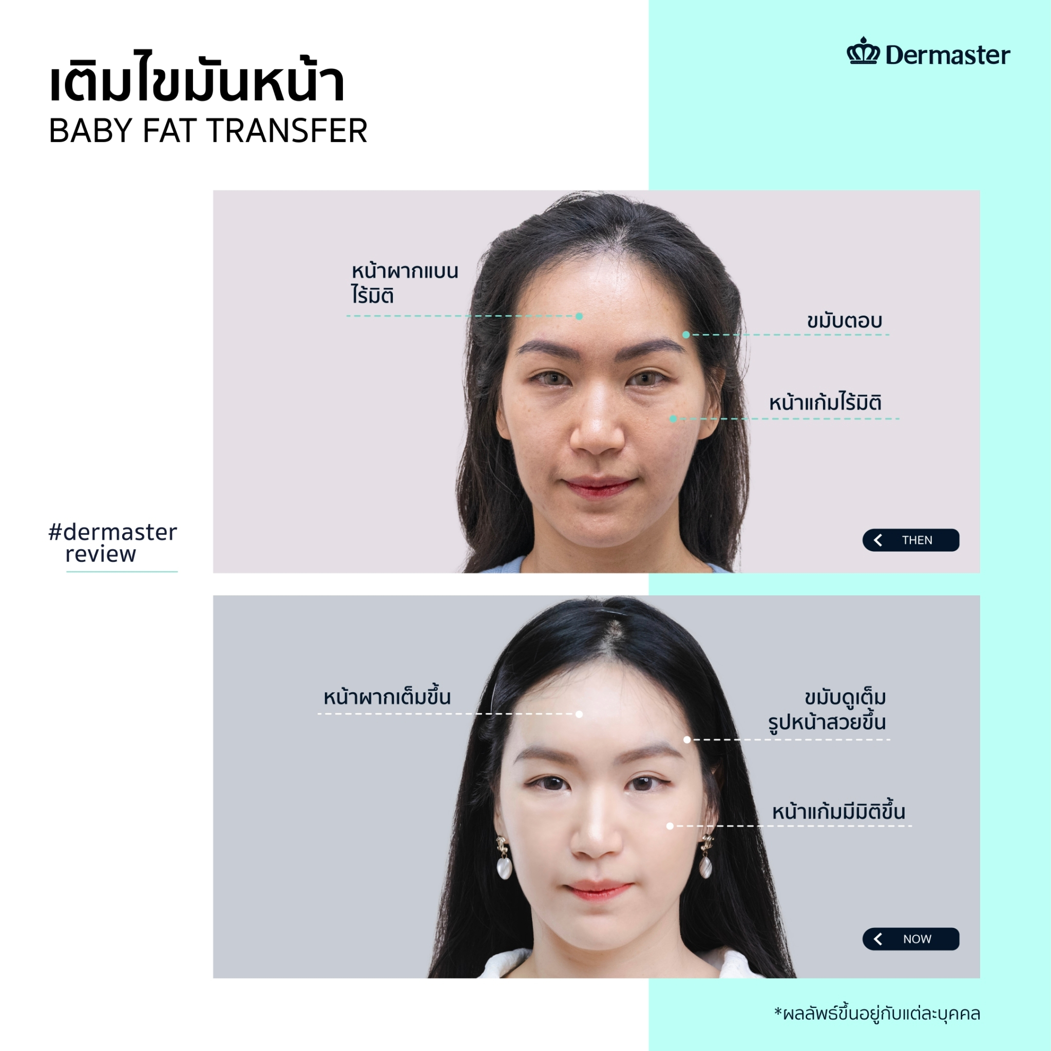 dermaster-thailand-baby-fat-transfer-before-and-after