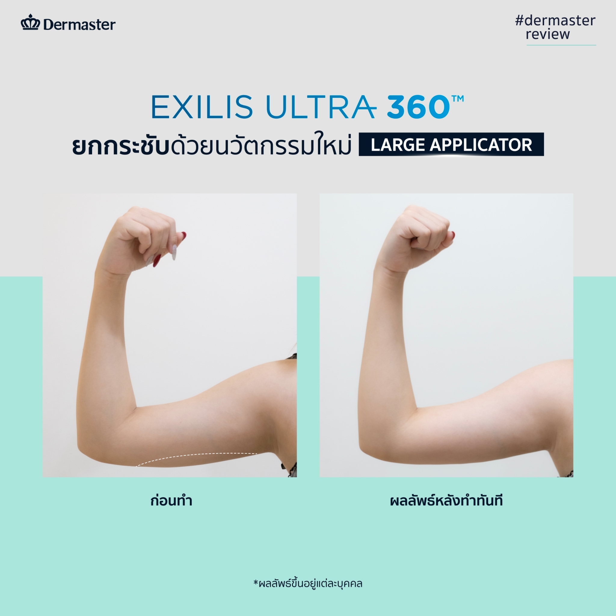 dermaster-thailand-exilis-ultra-360-review-whawha-2