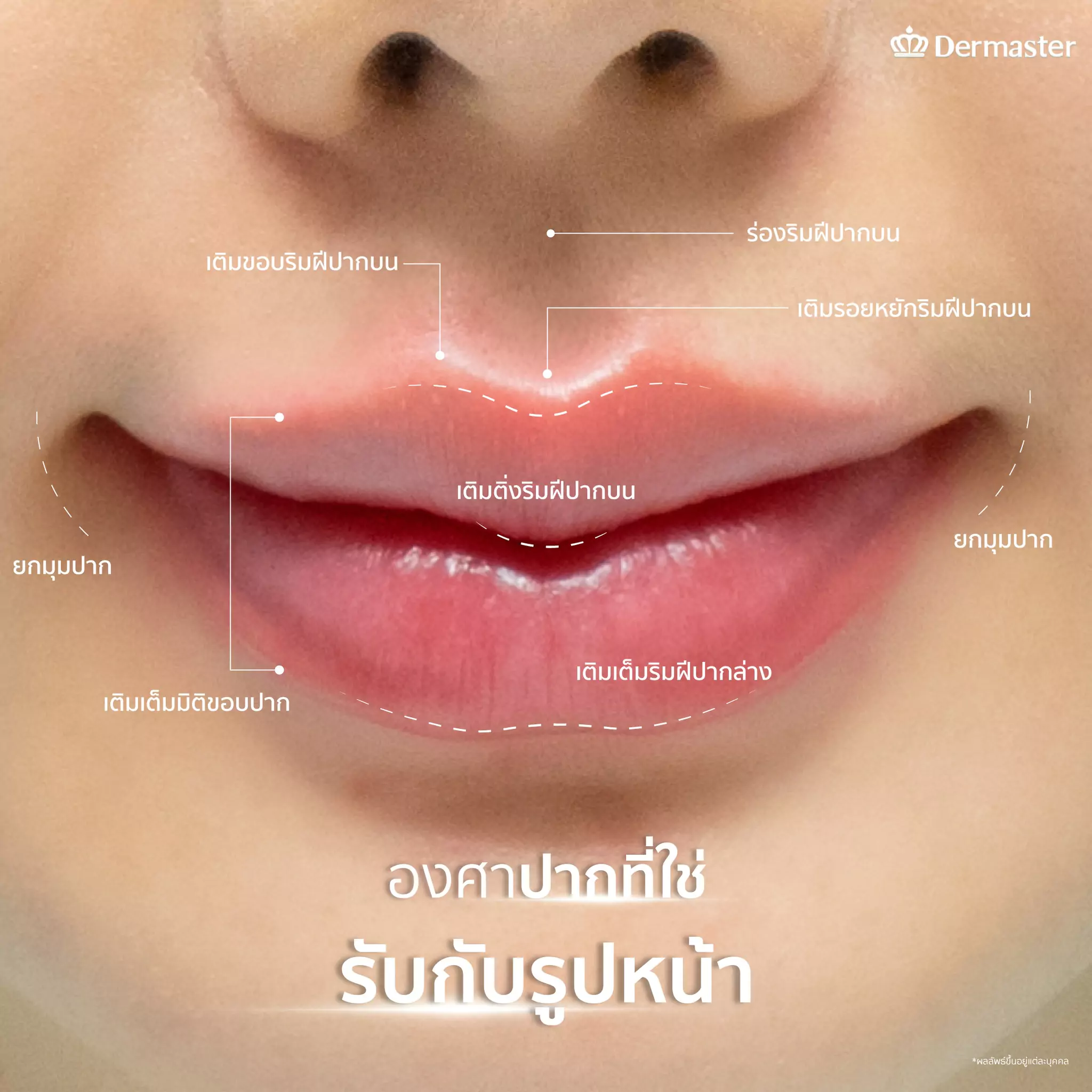 dermaster-thailand-lips-fillers-16