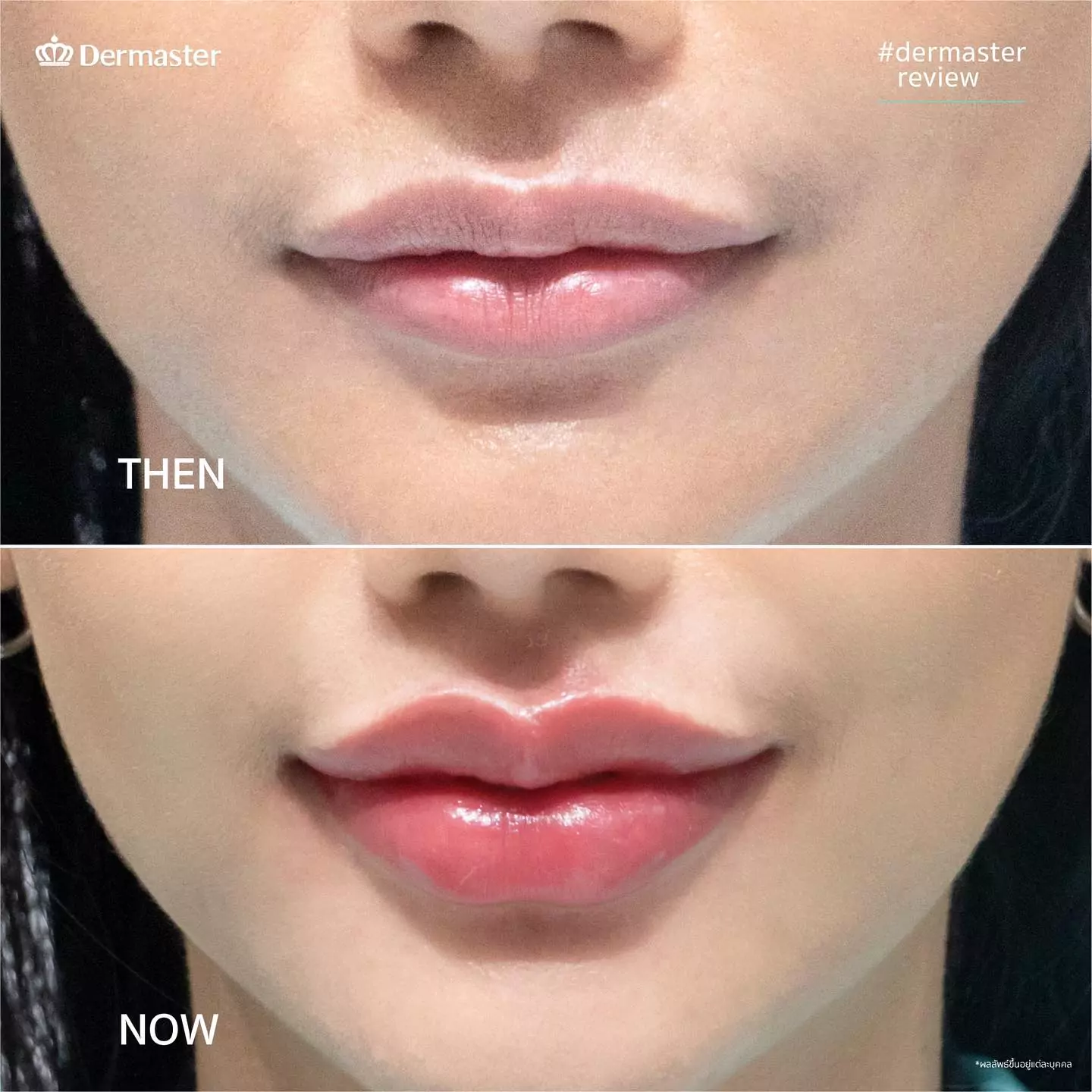 dermaster-thailand-lips-fillers-2