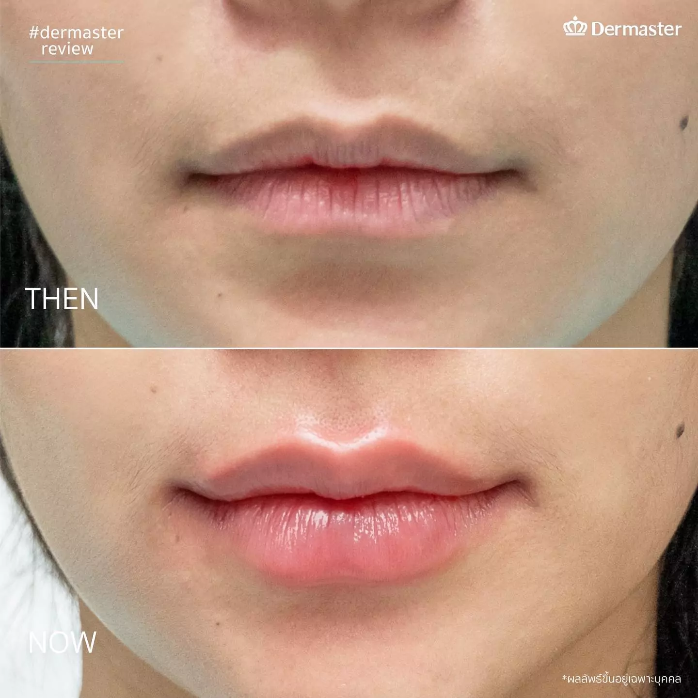 dermaster-thailand-lips-fillers-6