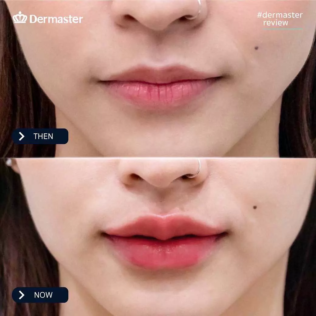 dermaster-thailand-lips-fillers-8