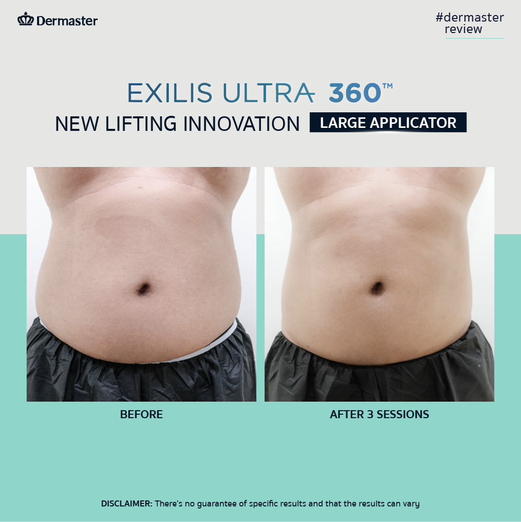 Image showing the review before and after of Exilis Ultra 360 for body fat reduction