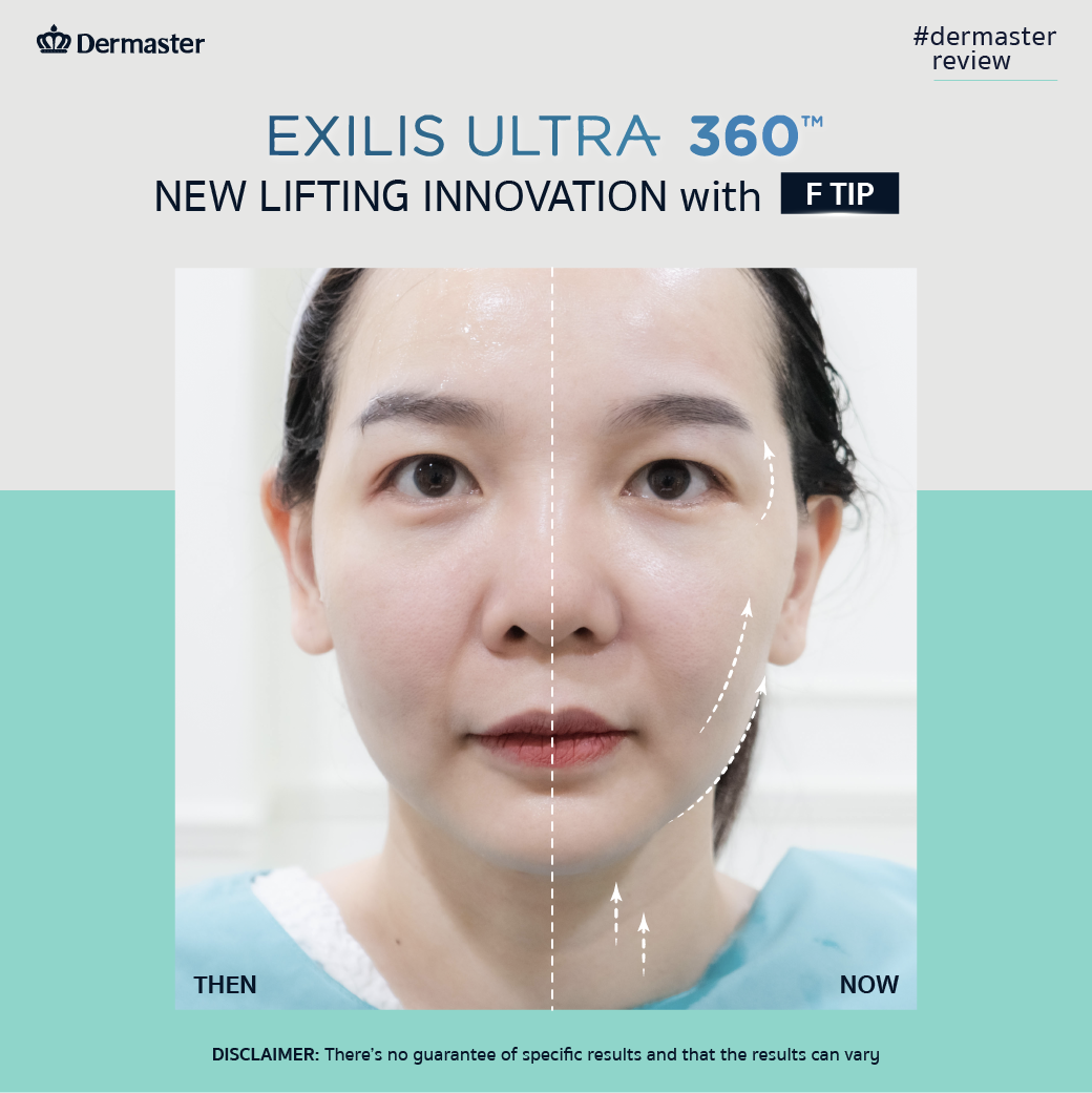 Image showing the review before and after of Exilis Ultra 360 for facial lifting 2