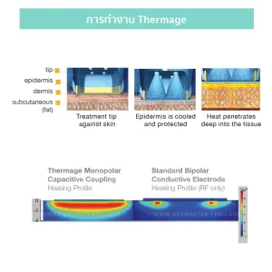 Unlocking Youthful Radiance: Understanding Thermage CPT for Skin Rejuvenation 5