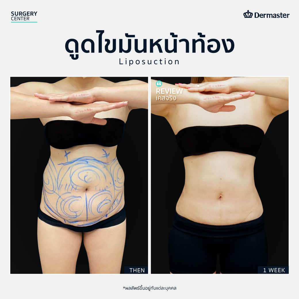 B&A-คุณนาหน้าท้อง-front