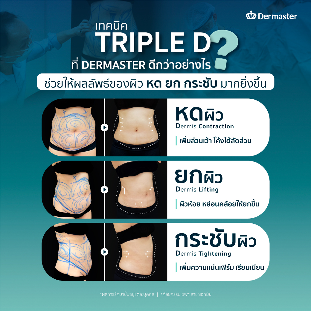 ดูดไขมัน-Triple-D