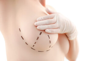 ราคาและระยะเวลาพักฟื้น เปรียบเทียบวิธียกกระชับหน้าอกในปี 2025