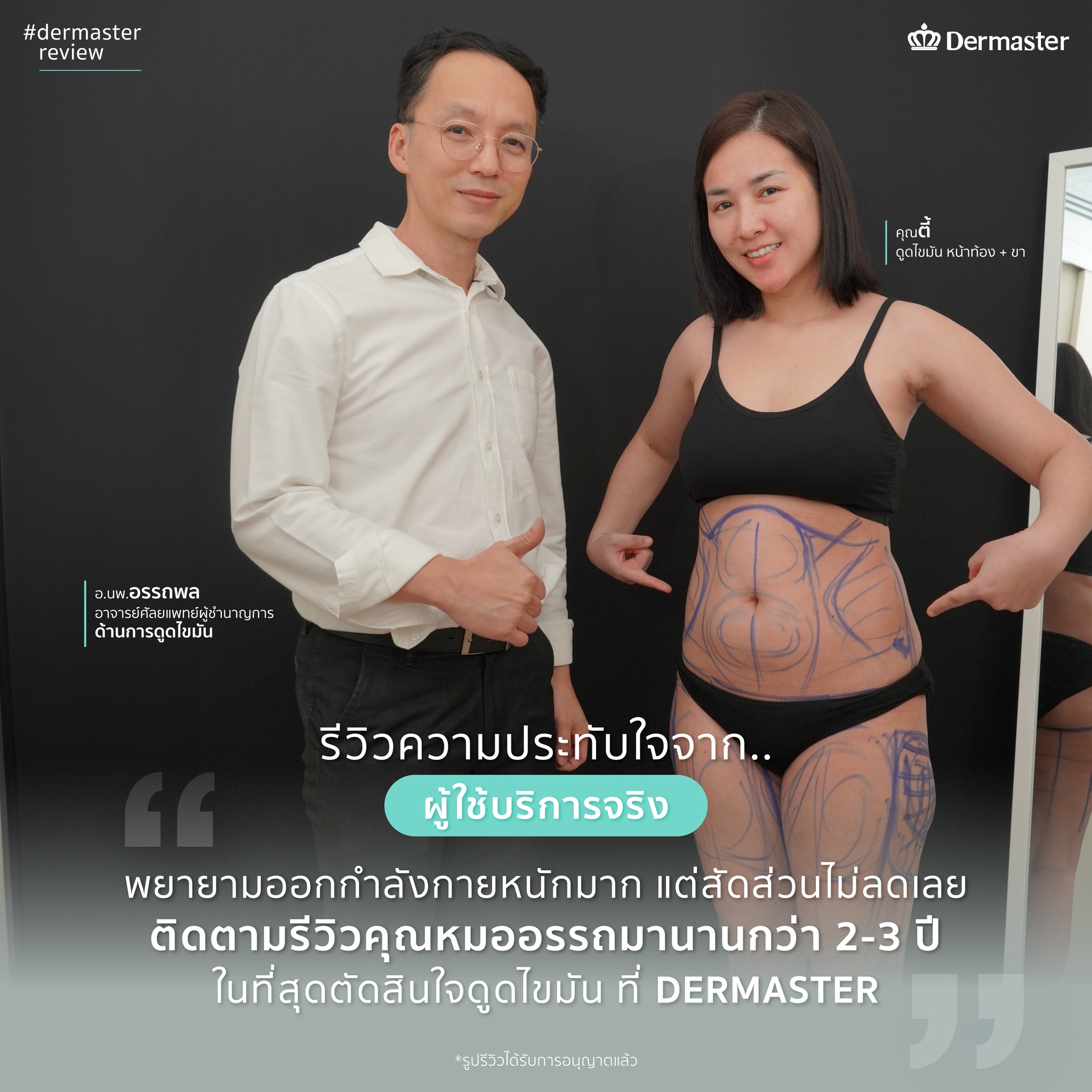 รีวิวลูกค้าจริง-ดูดไขมัน2