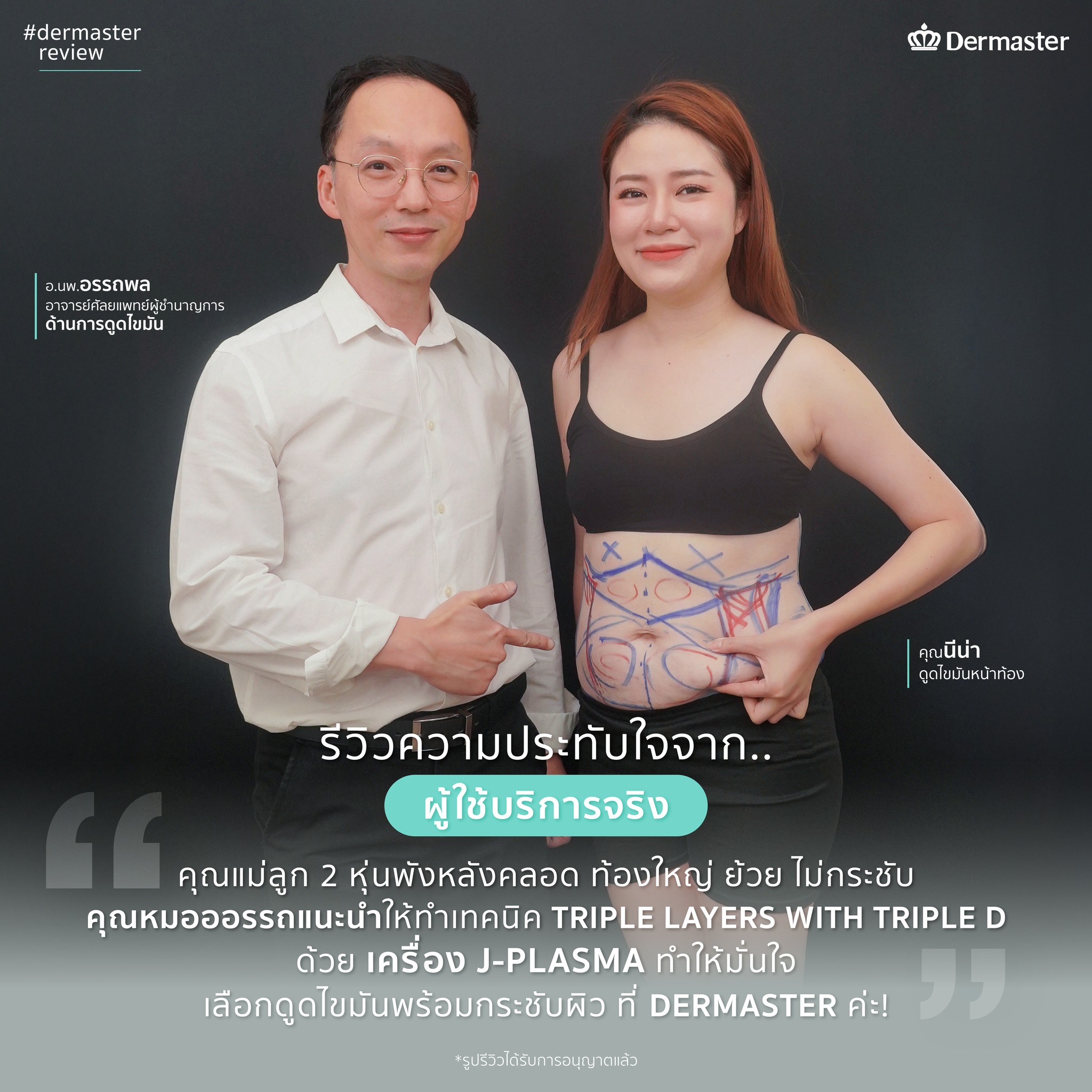 รีวิวลูกค้าจริง-ดูดไขมัน4