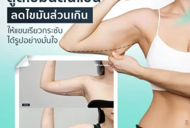 ดูดไขมันต้นแขน ลดไขมันส่วนเกิน